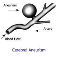 Brain Aneurysm